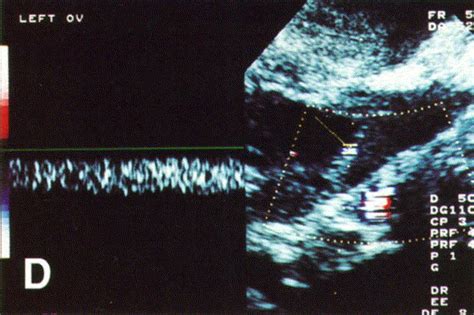 Early Detection Of Ovarian Carcinoma With Transvaginal Color Doppler