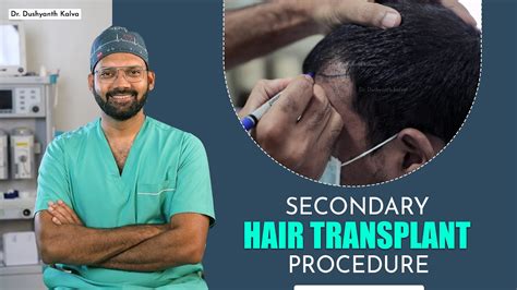 Corrective Hair Transplant Dr Dushyanth Kalva YouTube