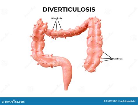 Diverticulosis Is A Gastrointestinal Disorder In Which Diverticula Form