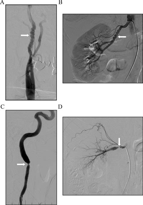 Fibromuscular Dysplasia Circulation