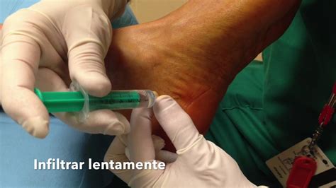 T Cnica De Infiltraci N Medial Para Fascitis Plantar Youtube