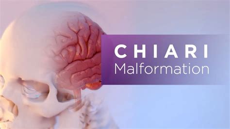 Chiari Malformation Youtube