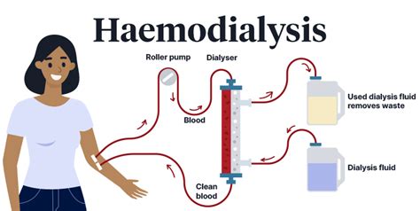 Dialysis Basics Ausmed