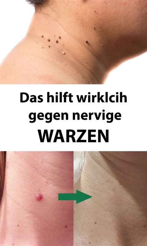 Warzen 10 Wege sie natürlich loszuwerden Beauty hacks Warts Beauty