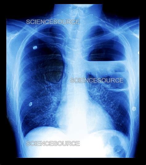 Photograph | Severe bullous emphysema | Science Source Images