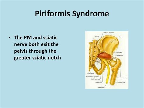 Piriformis Syndrome Causes