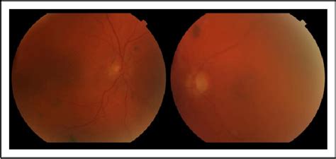 Figure From Successful Treatment Of Bilateral Diffuse Uveal