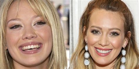 10 Celebrities with Veneers - Celebrities Who Had Major Teeth ...