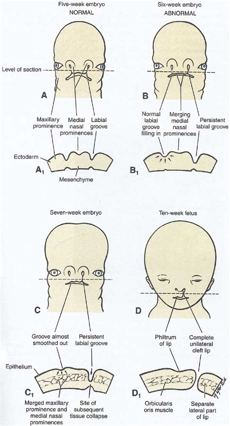 Table 1 From Part 1 Understanding The Embryology And Genetics Of Cleft