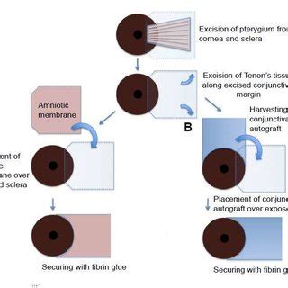 Schematic drawing of pterygium excision with AM transplantation (A) and ...