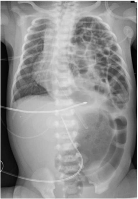 Chest X Ray Of The Left Sided Congenital Diaphragmatic Hernia Shortly