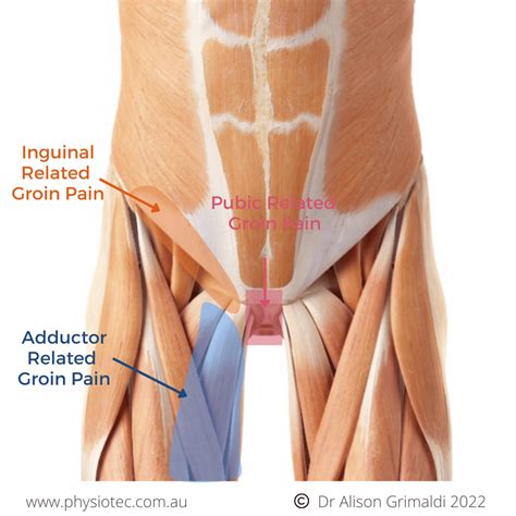 Physio For Hip Pain