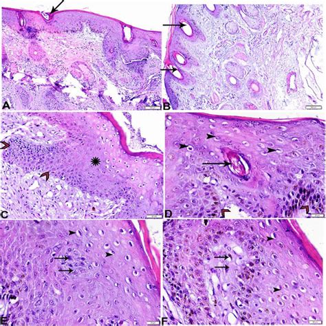 Photomicrograph Of Skin Nodular Tissue Sections Stained With Hxande Stain