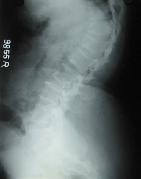 Achondroplasia Adult - Dr. Vasu