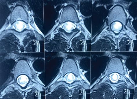 Preoperative magnetic resonance imaging (MRI) scan of the dorsal spine ...