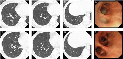 High Resolution Computed Tomography Hrct And Bronchial Thermoplasty