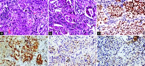 A And B Section Show Infiltrating Lesion Comprised Of Polygonal Cells