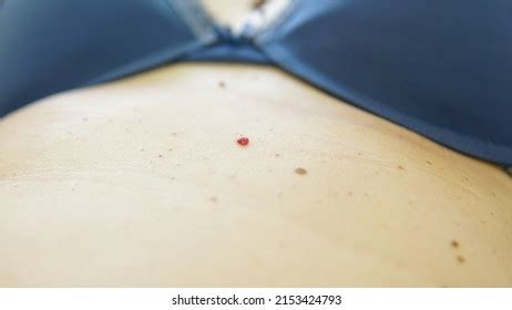 Red Moles Dots On Female Body Foto Stok Shutterstock