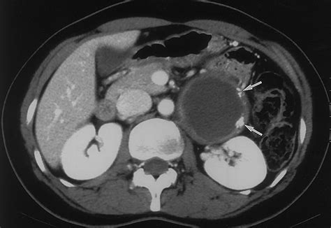 Neurogenic Tumors In The Abdomen Tumor Types And Imaging