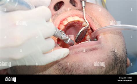 mouth bleeding at the dentist office Stock Photo - Alamy