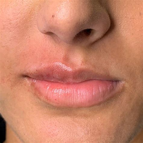 This Is A Split Image Of The Before And After Of A Clients First Lip