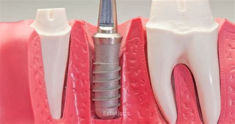 Implantes Dentales De Zirconio La Mejor Opci N Esteticas Ar