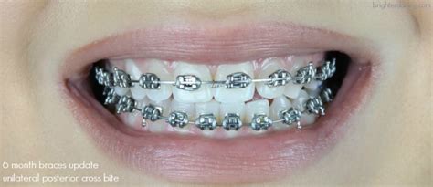 Adult Braces Update 5 Six Month Progress