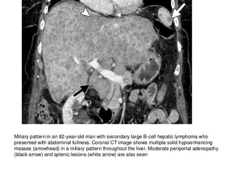 Hematologic Malignancies Of The Liver