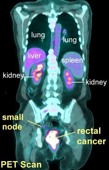 Pet Scan Colon Cancer