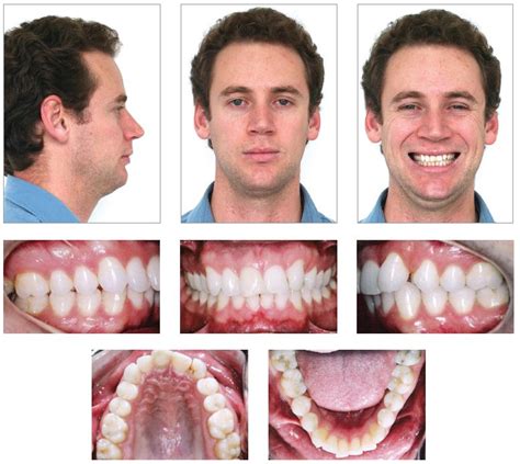 Scielo Brasil Agenesis Of Maxillary Lateral Incisor In An Angle