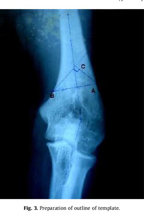 Figure 3 From Reverse V Osteotomy And Treatment Of Cubitus Varus