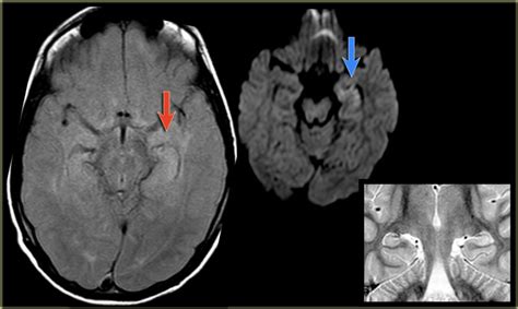 The Radiology Assistant : Brain - Epilepsy: Role of MRI