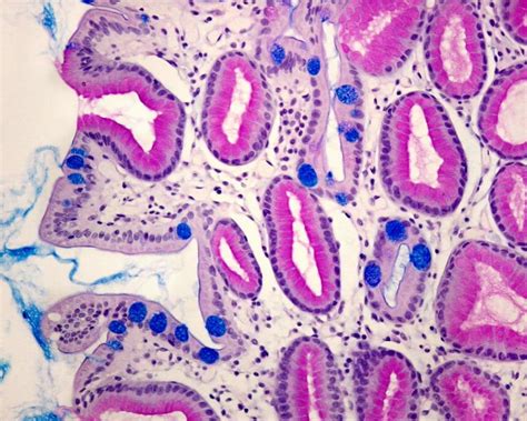 Gastric Intestinal Metaplasia Aga Guidelines Gastroenterology