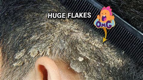 Huge Dandruff Flakes Combing Dandruff Scratching YouTube