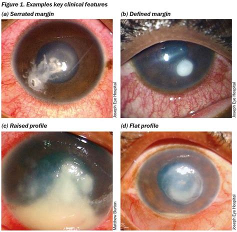 Fungal Keratitis Medizzy