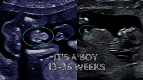 Ultrasound Pregnancy Showing Boy Gender 13 Weeks To 36 Weeks Key