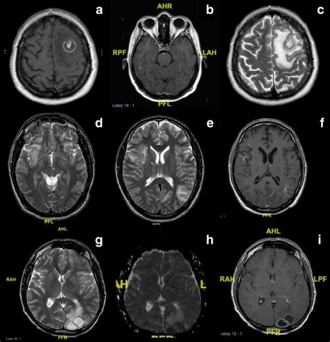 Encephalitis Mri