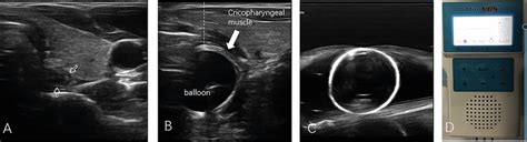 Ultrasound imaging of cricopharyngeal muscle and picture of the EMG ...