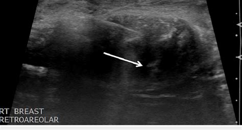 Core Needle Biopsy Ultrasound Guided Core Needle Biopsy Of The Right