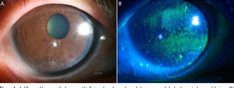 Figure 1 From Tear Film And Drainage After Selective Punctal Occlusion