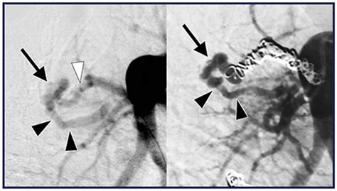 Transarterial Embolization Of Simple Pulmonary Arteriovenous