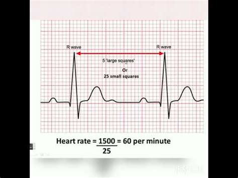 Ekg Heart Rate Calculator