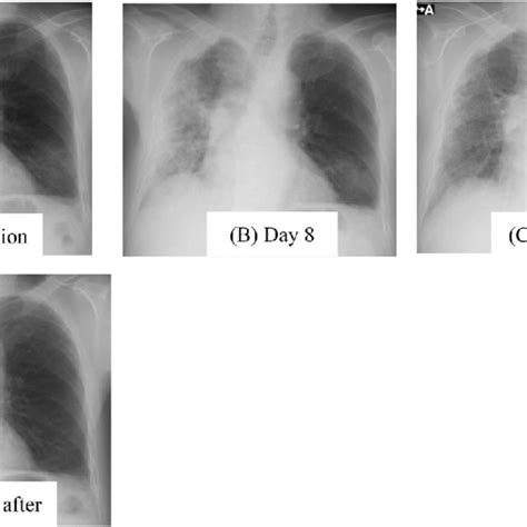 Chest X Rays In Case 1 Chest X Ray On Admission A Showed