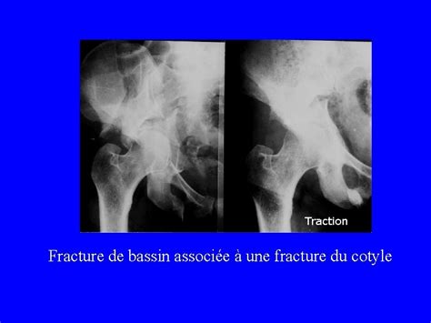 Fractures Du Bassin Classification Des Fractures Du Bassin