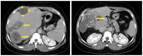 Diagnostics Free Full Text Hydatid Disease A Radiological