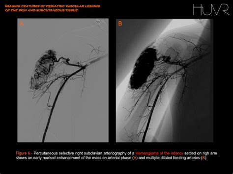 Figure 6 From Imaging Features Of Pediatric Vascular Malformations Of The Skin And Subcutaneous