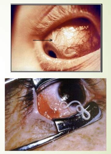Nematode African Eye Worm Flashcards Quizlet