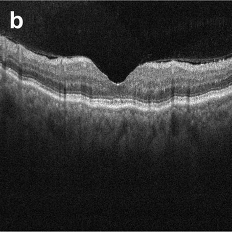 Ultrasound Biomicroscopy Scans Oct B Scan And Macular Vd Image Of