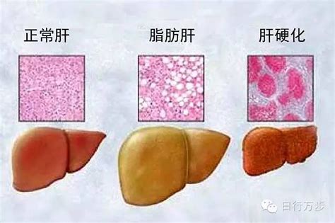 1 5亿脂肪肝患者有希望了 中国科学家非酒精性脂肪肝炎研究获突破