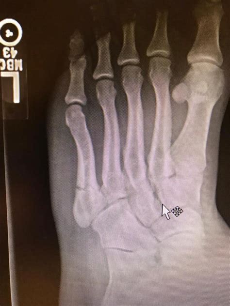 5th Metatarsal Fracture Statpearls Ncbi Bookshelf